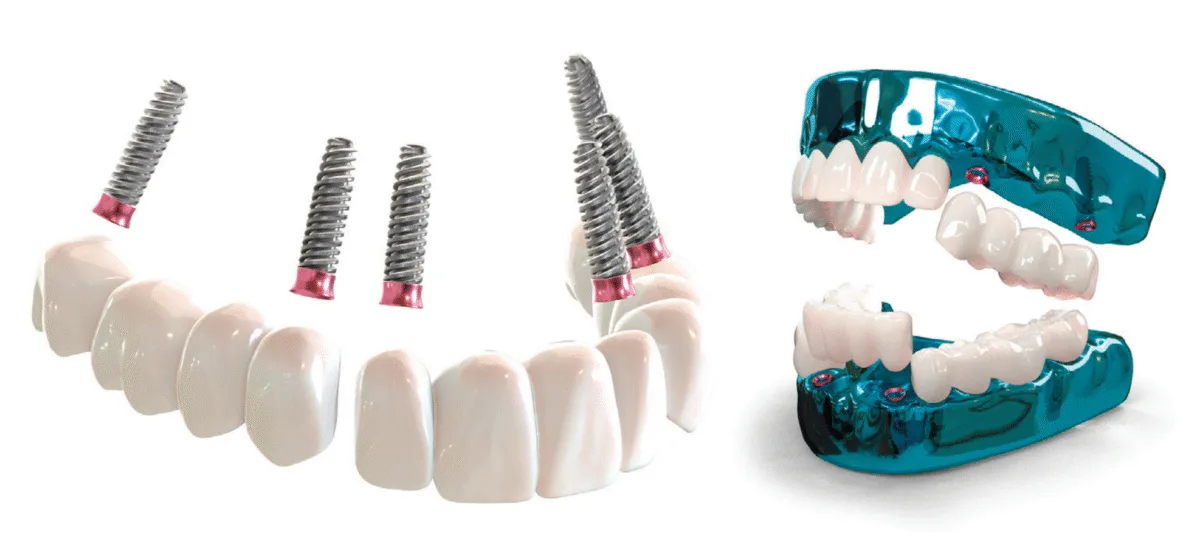 3D renderings showing the 3 on 6 bridges and TRI implants